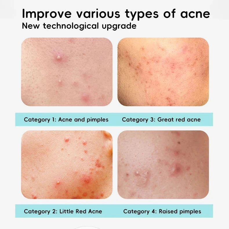 GlowSpot™ LED Acne Therapy Patch